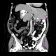 Situs viscerum inversus: CT - Computed tomography